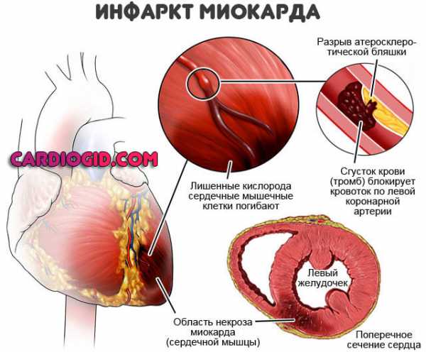 Симптомы инфаркта миокарда и ишемической болезни сердца у мужчин